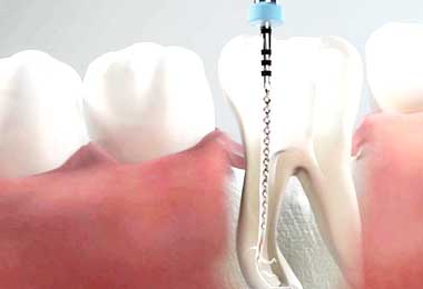Endodonzia conservativa